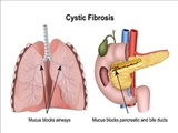 دستورالعملهای بالینی وزارت 1400- نسخه دوم پروتکل تشخیصی و درمانی بیماری سیستیک فیبروزیس (Cystic Fibrosis)