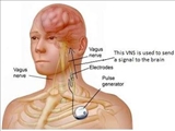 دستورالعملهای بالینی وزارت 1400- استاندارد درمانی VNS (vagal nerve stimulation) جهت درمان صرع مقاوم- مراکز