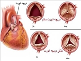 دستورالعملهای بالینی وزارت 1400- تعویض دریچه آئورت بدون نیاز به بخیه Sutureless AVR