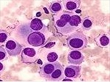 CD22-targeted CAR-T therapy shows promising results in relapsed large B-cell lymphoma