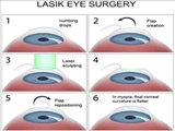 LASIK is a type of refractive surgery